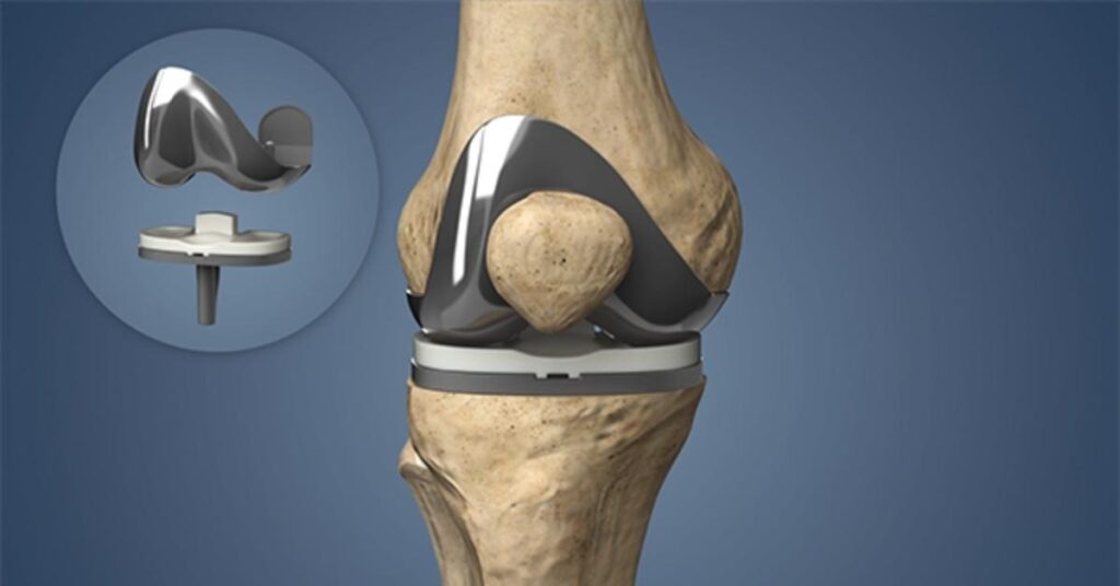 Acibadem Health Point Knee Replacement